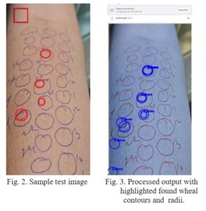 Skin Allergy Detection